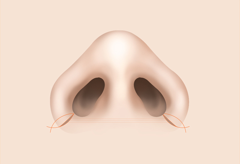 小鼻切開