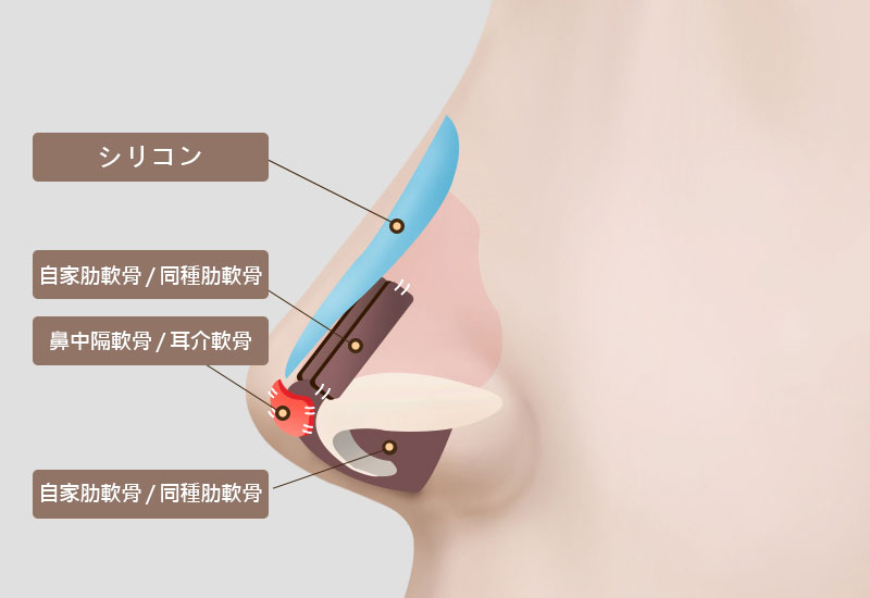 自家軟骨の活用