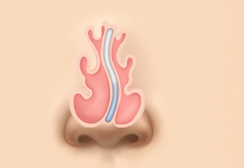 鼻中隔弯曲症の矯正