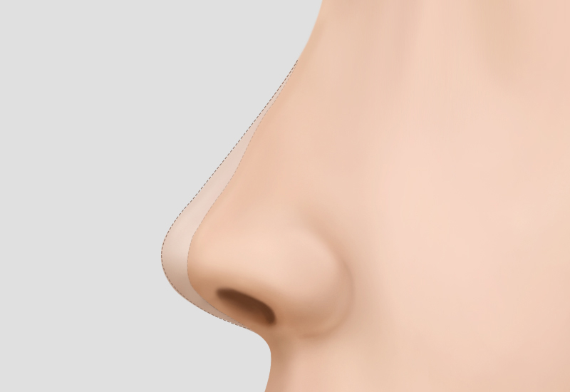 再手術デザイン