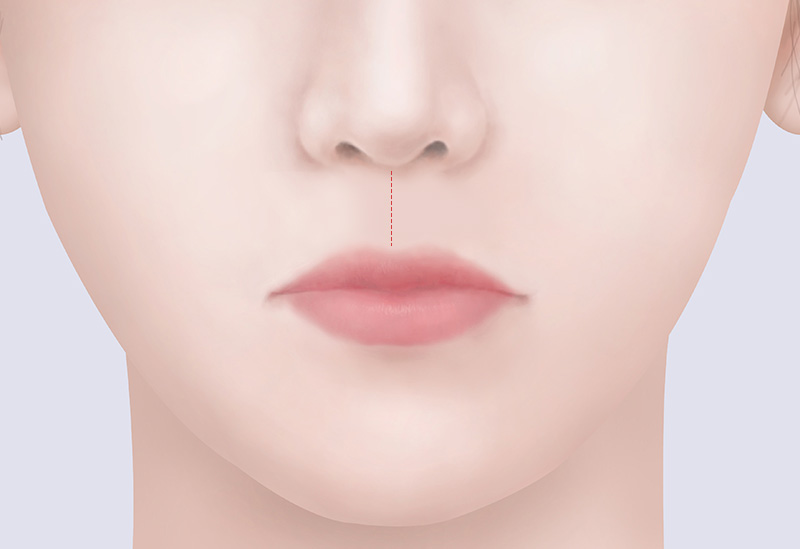 口腔内最小切開