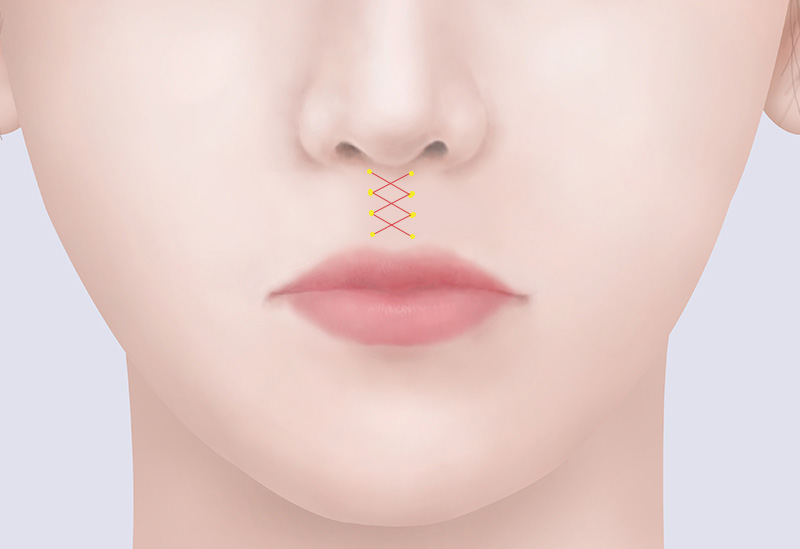 縫合および形態矯正