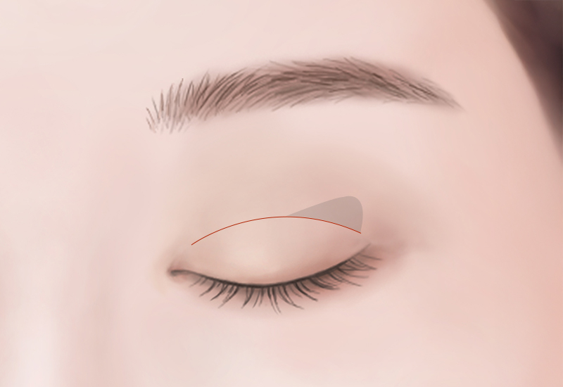 切開および目元矯正