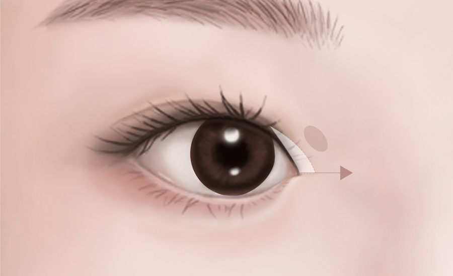 目頭・目尻切開