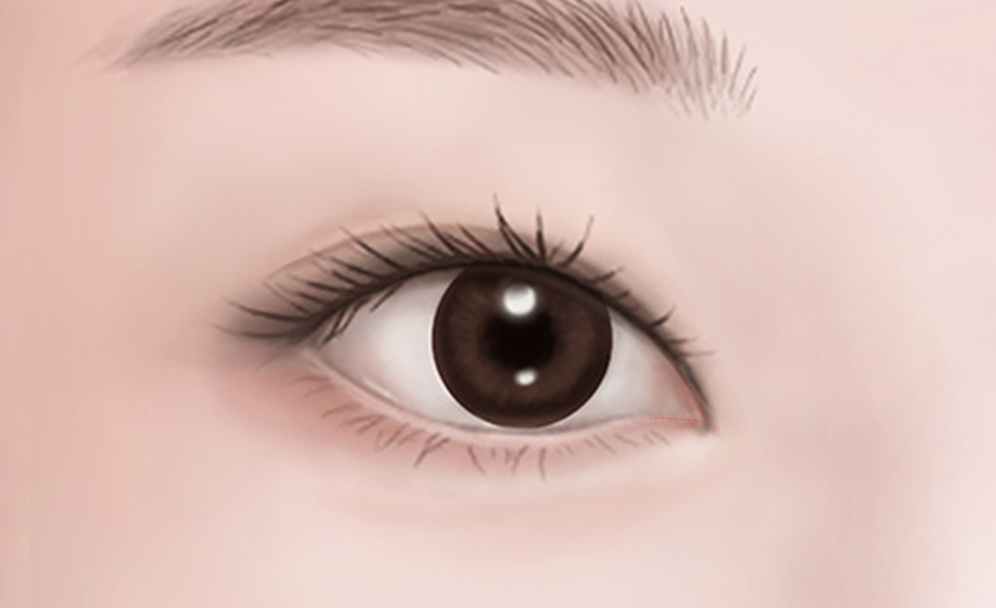 目頭・目尻切開