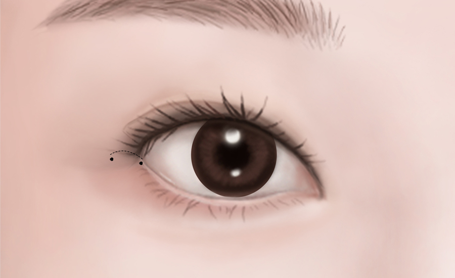 目頭・目尻切開