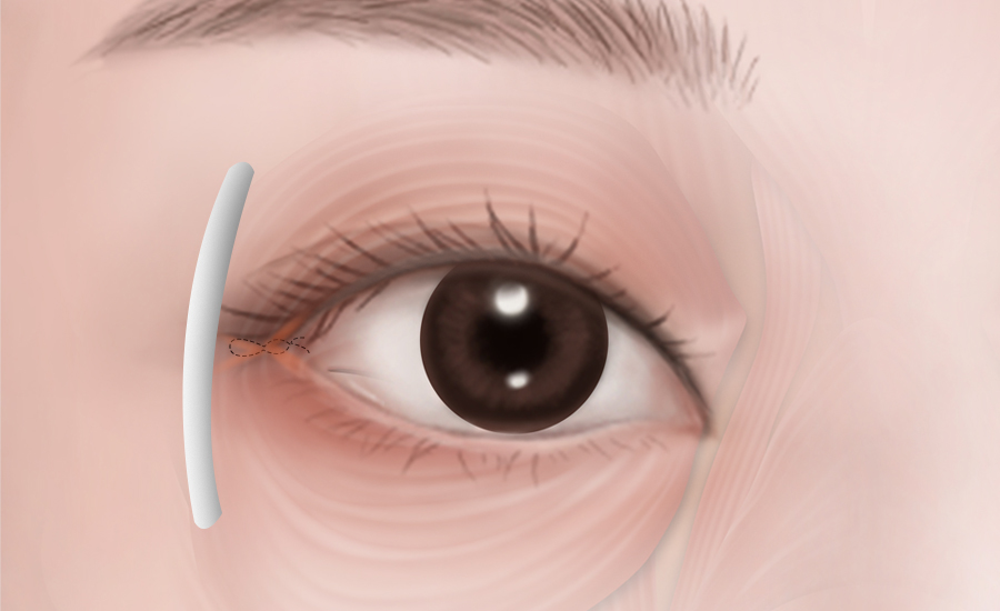 目頭・目尻切開