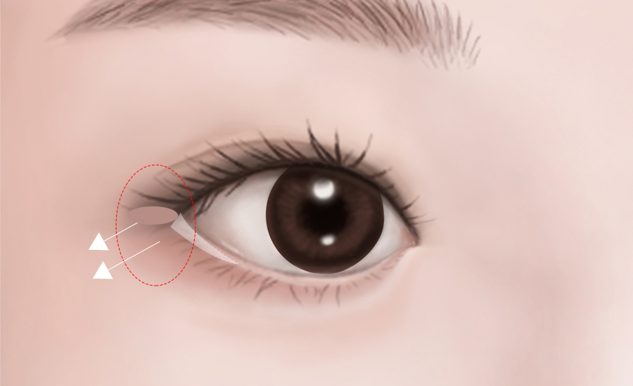 目頭・目尻切開