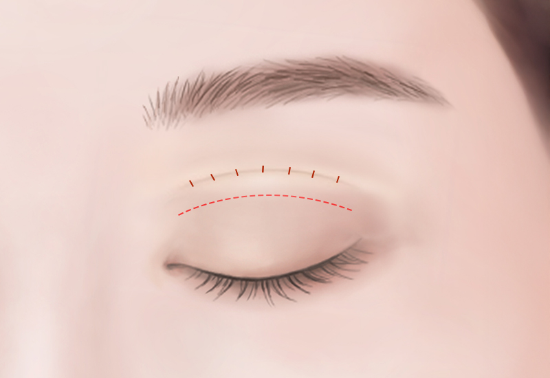 癒着除去と矯正