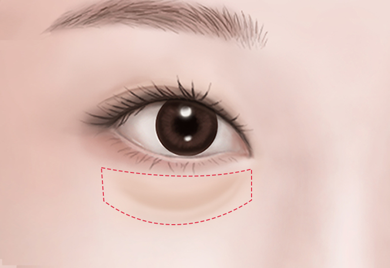 結膜切開と脂肪整理