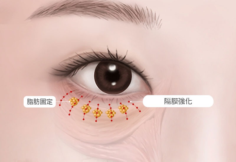 縫合および回復