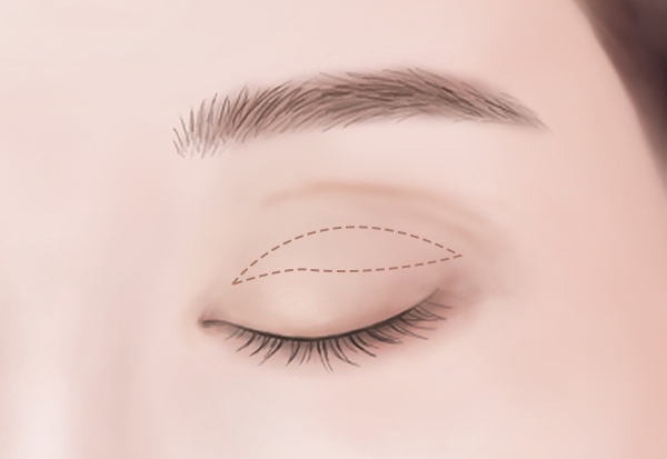 上眼瞼・下眼瞼