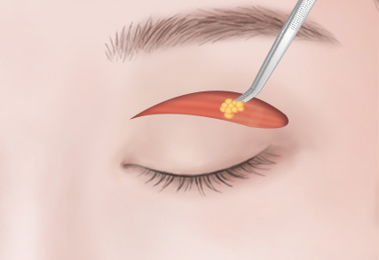 上眼瞼・下眼瞼