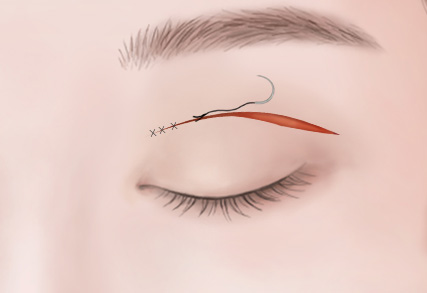 上眼瞼・下眼瞼