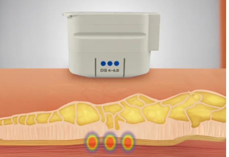 一定で均一なリフティング効果