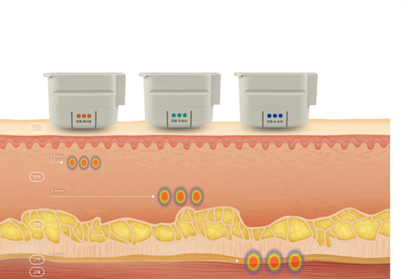 皮膚層に合わせた施術